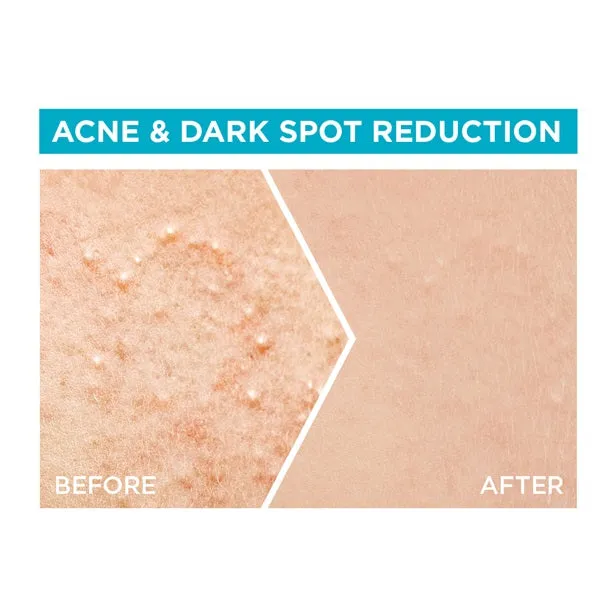 Fast Clear 4% Salicylic Acid, Vitamin C, Niacinamide, AHA - Anti-Acne Treatment Booster Serum